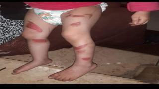 الطفلة ضحية التعذيب .