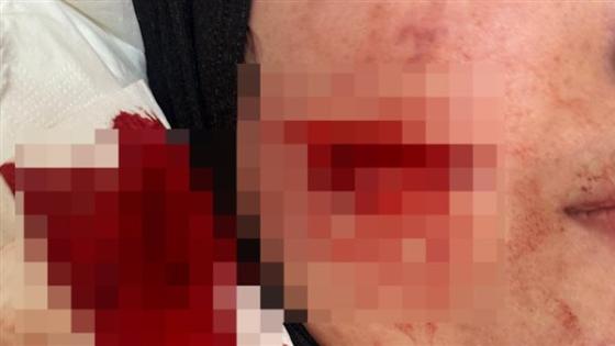 تفاصيل التقرير الطبي للطالبة روان سعيد بعد الاعتداء عليها أمام جامعة الإسكندرية