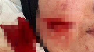 47 سم دمرت ملامحها.. التقرير الطبي لـ”روان” ضحية اعتداء خطيبها السابق أمام آداب الإسكندرية