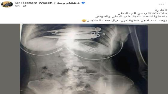 جراح يكشف صدمة.. مطواة قرن الغزال في صدر سيدة بعد أشعة البطن