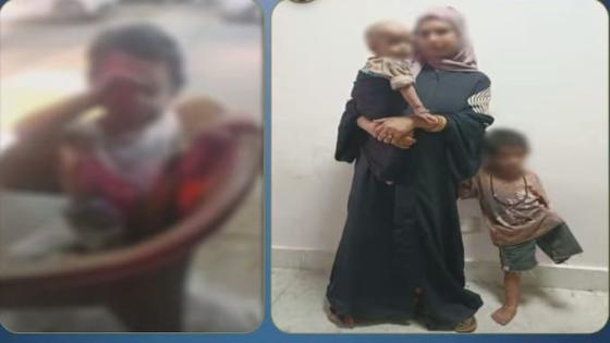 أم تستغل طفليها في التسول بالغربية.. إصابة طفلة بحروق في الوجه وبتر ساقها