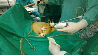 عملية تكميم المعدة تقود جزار طنطا للموت