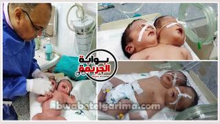 بالصور .. وصول طفل برأسين من أسوان لمستشفى أسيوط الجامعى لتلقى العلاج